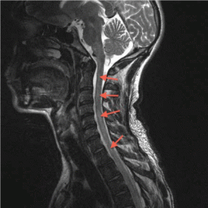 etanercept-induced lupus